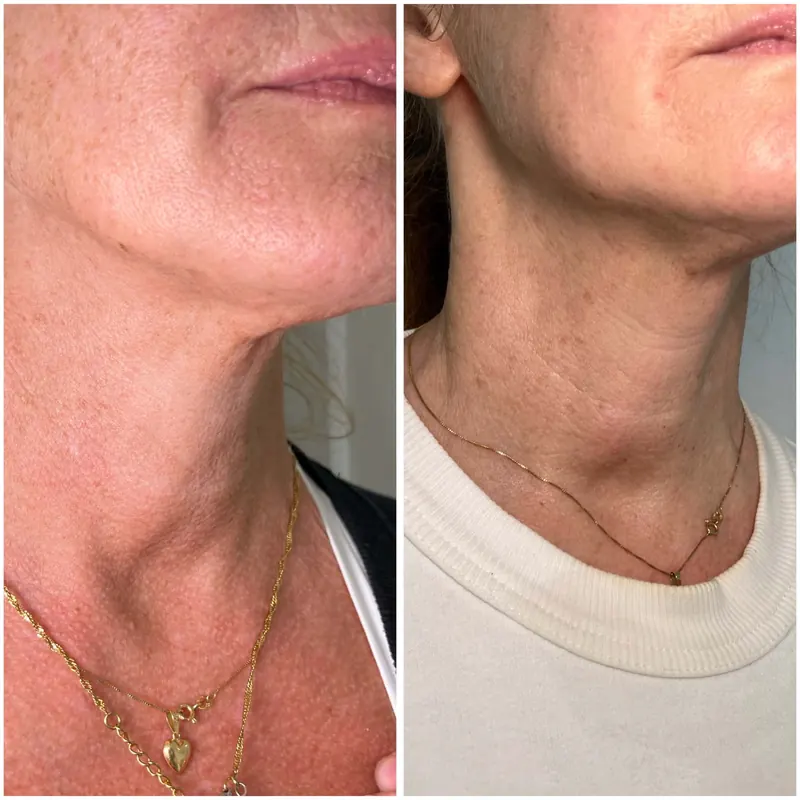 Hals och käklinje, före till vänster och efter till höger